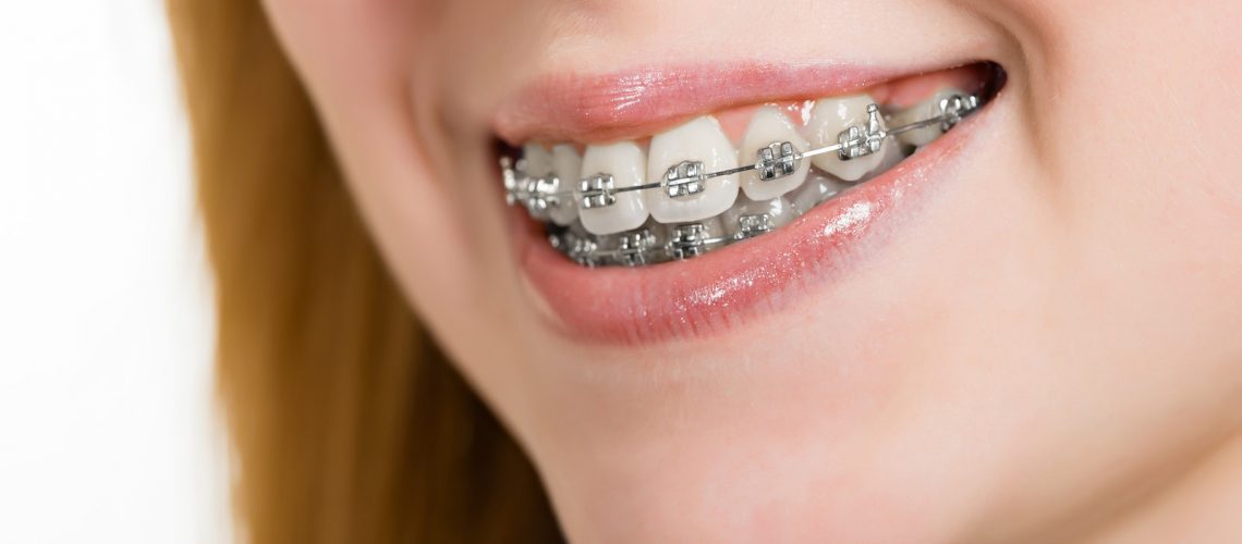 Got Braces? Use Oral-Care Probiotics