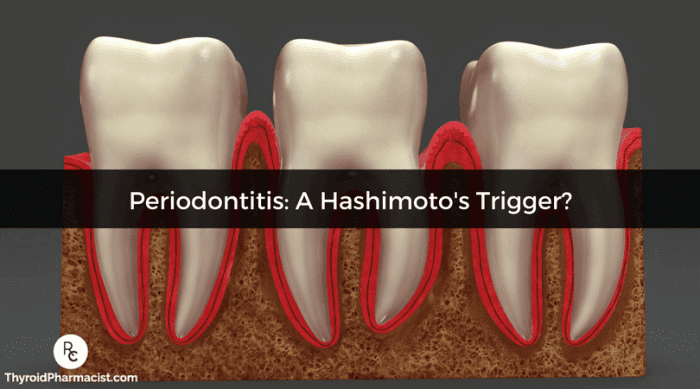 Periodontitis, A Trigger For Hashimoto’s?